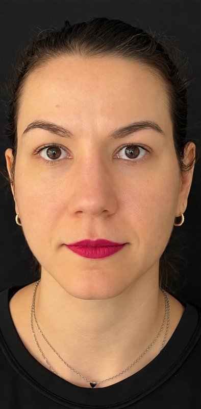 Caso 03, depois da cirurgia