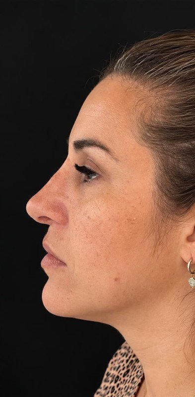 Caso 04, depois da cirurgia
