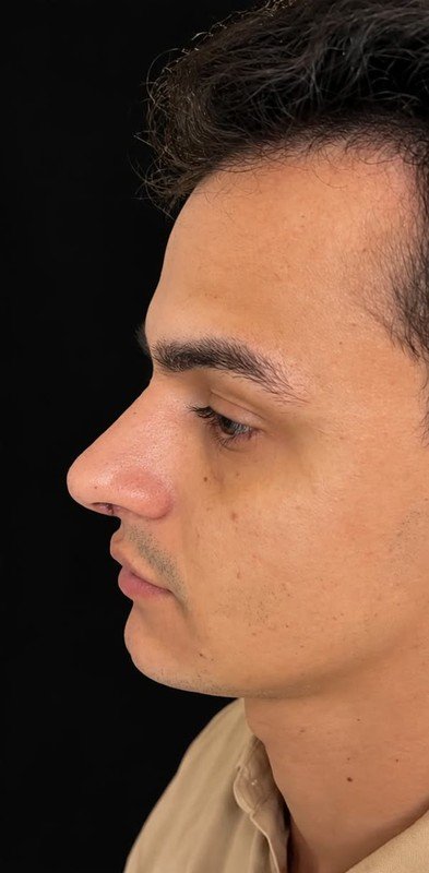 Caso 10, depois da cirurgia