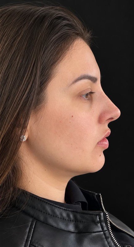 Caso 11, depois da cirurgia