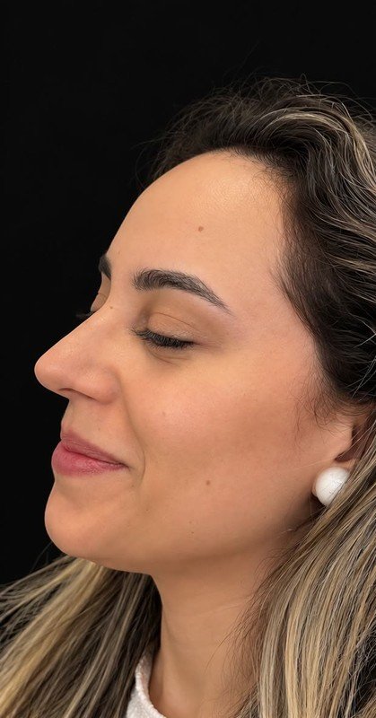 Caso 17, depois da cirurgia
